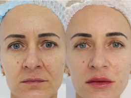 revanesse dermal filler