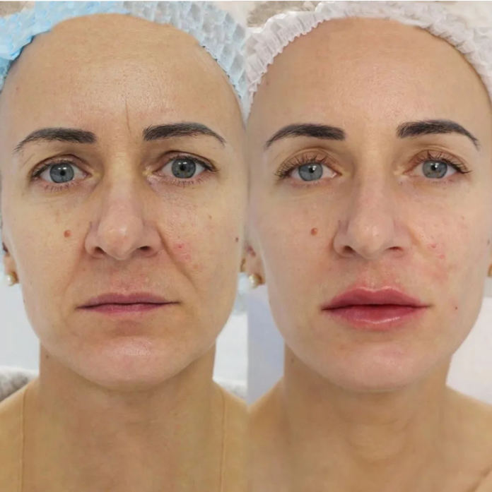 revanesse dermal filler