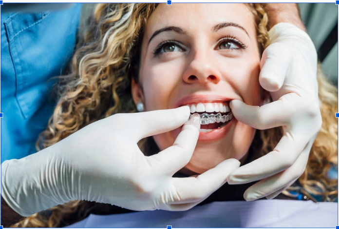 teenager aligners